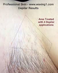 It can reach too high a temperature and burn the sensitive skin around the warm up the wax. Depilar Permanent Hair Reduction Proskin Brazilian Waxing Salon