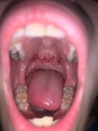 Image result for Physical injury red spots roof of mouth
