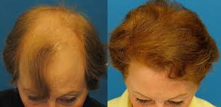 Both permanent and temporary hair dyes contain harsh chemicals. Hair Color Products Cause Hair Loss Hairsite Com
