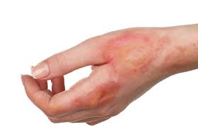 We did not find results for: Best Home Remedies For Burns And How To Treat Them Howzak Com