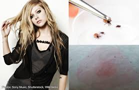 Avril Lavigne Feared Dying From Lyme Disease Health Health Health News Asiaone