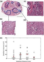 Tumour incident histological finding in more than 5% of tissue retracted. Histopathology Derived Modeling Of Prostate Cancer Tumor Control Probability Implications For The Dose To The Tumor And The Gland Radiotherapy And Oncology