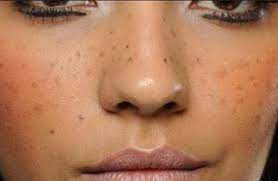 Cara menghilangkan jerawat di photoshop. Cara Alami Menghilangkan Flek Di Wajah Cara Menghilangkan Flek Hitam Di Wajah Menghilangkan Flek Hitam Cara Alami Minyak Zaitun Wajah Flek Hitam Bintik Bintik