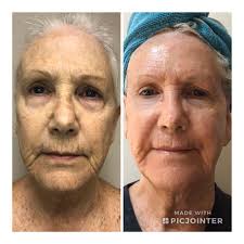 fully ablative laser resurfacing near me