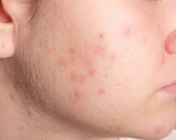 La sclérodermie cutanée localisée c'est la forme la moins grave de la maladie. Acne Stades Solutions Remedes Naturels