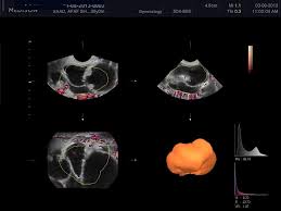 The umbilical cord color doppler wavefronts could first be obtained on day 46 and became increasingly distinct thereafter. Three Dimensional Power Doppler Ultrasonography In Evaluation Of Adnexal Masses Sciencedirect