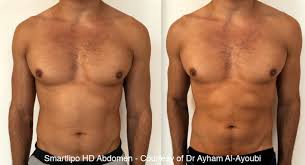 Soto a smartlipo specialist in omaha. Smartlipo London Uk S Most Advanced Clinic 5 Rated