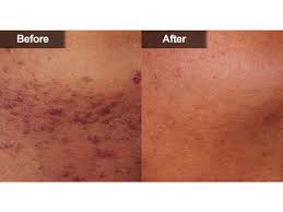 Hair removal lasers work best on dark, coarse hair. Laser Hair Removal Mclean Woodbridge Va Skin Laser Center