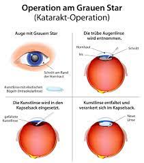 Grauer Star Op Katarakt Operation