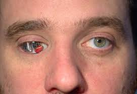 Une évidence qui saute aux yeux [j. Un Homme Perd Son Oeil Droit Dans Un Accident Ce Qu Il Pose Dans Sa Paupiere Pour Le Remplacer Choque Tout Le Monde Une Pomme Par Jour