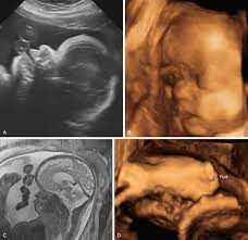 Ultrasound Features Of Fetal Syndromes Radiology Key