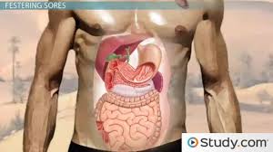 Peptic Ulcer Disease Types Causes And Treatments Video Lesson Transcript Study Com