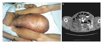 Image result for Inguinal hernia man