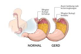 Gastritis dibagi menjadi dua jenis, yaitu gastritis akut dan kronis. Penyakit Asam Lambung Gejala Penyebab Dan Mengobati Alodokter