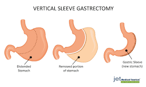 How much does gastric sleeve surgery cost with and without insurance? Gastric Sleeve Cost In Mexico Vertical Sleeve Cost Tijuana Mexico Vs U S