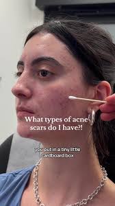 Let’s find out what types of scars I have and what’s next in my healing  journey 🥰 full podcast episode debunking skin myths with Dr. Danny Guo