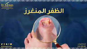 أسباب وعلاج الظفر المنغرز - مجمع د. خالد ادريس الطبي