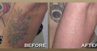 Wrinkle Removal Los Angeles The Skinpeccable Team Offers Excellent Services In Facials And Welcome Walk Ins A Tattoo Removal Tattoo Removal Cost Laser Tattoo
