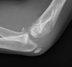 Image result for Elbow Dislocation