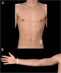 Since the 1800s, infectious mononucleosis has been recognized as a clinical syndrome consisting of fever, pharyngitis, and adenopathy. Amoxicillin Associated Rash In Glandular Fever Bmj Case Reports