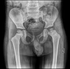 Image result for Perthes Test