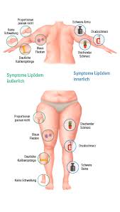 Bei Einem Lipodem Lagern Sich Krankhafte Fettzellen An Bestimmten Korperstellen Ab Viele Betroffene Leid Liposuktion Fitnessfakten Lymphdrainage Selber Machen
