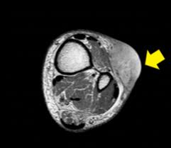 It may spread quickly to surrounding tissues, nearby lymph nodes, or more distant parts of the body. Cureus Anti Egfr Antibody Plus Chemotherapy Treatment In A Patient With Synchronous Merkel Cell Carcinoma And Colorectal Cancer