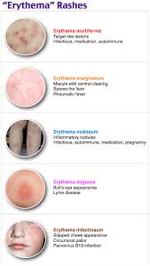 Image result for erythema nodosum