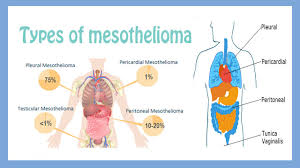This cancer develops in the layer of tissue that covers many internal organs in the body. What Causes Malignant Mesothelioma Dfives
