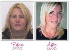 Pin On Hypothyroidism Natural Treatment