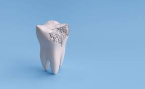 A root canal is a procedure to treat, relieve pain, and save a tooth that becomes infected and inflamed due to decay. How To Fix Tooth Enamel Erosion