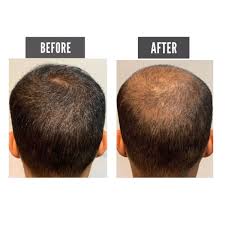 Apa punca sebenar rambut gugur ni? Lespettua On Twitter Lelaki Risau Betul Bila Rambut Dah Start Nampak Nipis Korang Mesti Hairan Kan Kenapa Rambut Tiba2 Gugur And Start Nipis From Lebat Suddenly Jadi Makin Nipis And Jarang