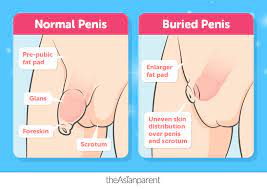 Weapons of penile smooth muscle destruction: Buried Penis Syndrome In Baby Boys What You Need To Know