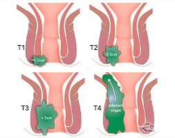 Image result for Anal Cancer