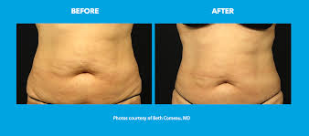 Maybe you would like to learn more about one of these? Coolsculpting Before After Photos Dr Beth Comeau Md