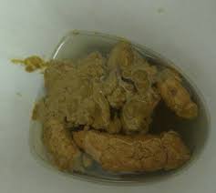 Image result for yellow stool human poop