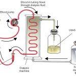 Sakit buah pinggang tahap 4. Kegagalan Buah Pinggang Renalteam