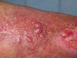 Whites are much more likely to be affected by this skin cancer than are blacks. Merkel Cell Carcinoma Critical Review With Guidelines For Multidisciplinary Management Bichakjian 2007 Cancer Wiley Online Library
