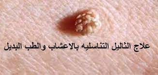 شعور جيد تدفق أندرو هاليداي علاج الثآليل التناسلية عند الرجال dsvdedommel com