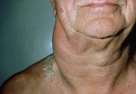Swollen Lymph Nodes Heart And Blood Vessel Disorders Merck Manuals Consumer Version