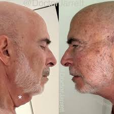 Neck Lift & Décolleté