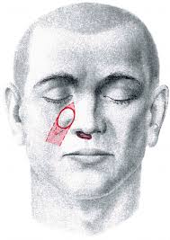 Tumor Operations of the Face and Scalp