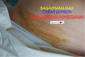 Luka yang besar macam luka pembedahan memang akan sedikit lambat sembuh. Sweet Moms Vitamin Cantik Dan Sihat Dengan Vitamin Semulajadi Shaklee Cara Sembuhkan Luka Bersalin Pembedahan Dengan Cepat