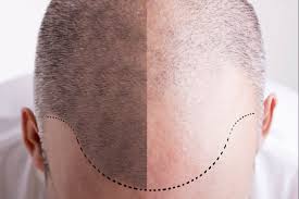 Faux cheveux homme / faux cheveux homme : Le Tatouage De Cuir Chevelu Nouvelle Tendance Masculine Masculin Com