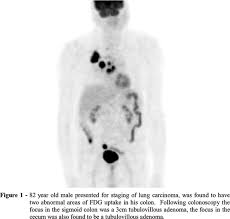 It is often done before surgery (see types of treatment). Scielo Brasil Pet And Pet Ct Imaging For The Earliest Detection And Treatment Of Colorectal Carcinoma Pet And Pet Ct Imaging For The Earliest Detection And Treatment Of Colorectal Carcinoma