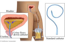 Image result for Urethral Catheterization