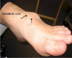 A swollen prostate can make it hard. Tumors Of The Foot Causes And Treatment Options Myfootshop Com