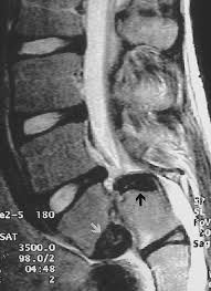 Image result for Low Back Imaging