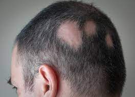 When your body converts testosterone to the less useful dihydrotestosterone (dht), you can experience hair loss. Sudden Hair Loss Can Happen To Anyone Health Beat