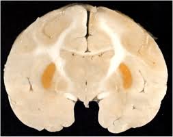 Image result for Kernicterus